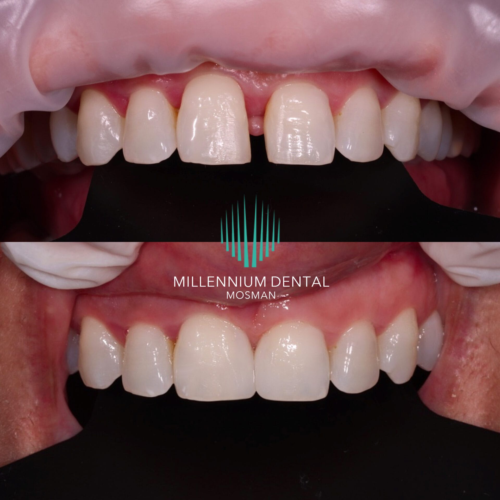 Before and after for composite bonding