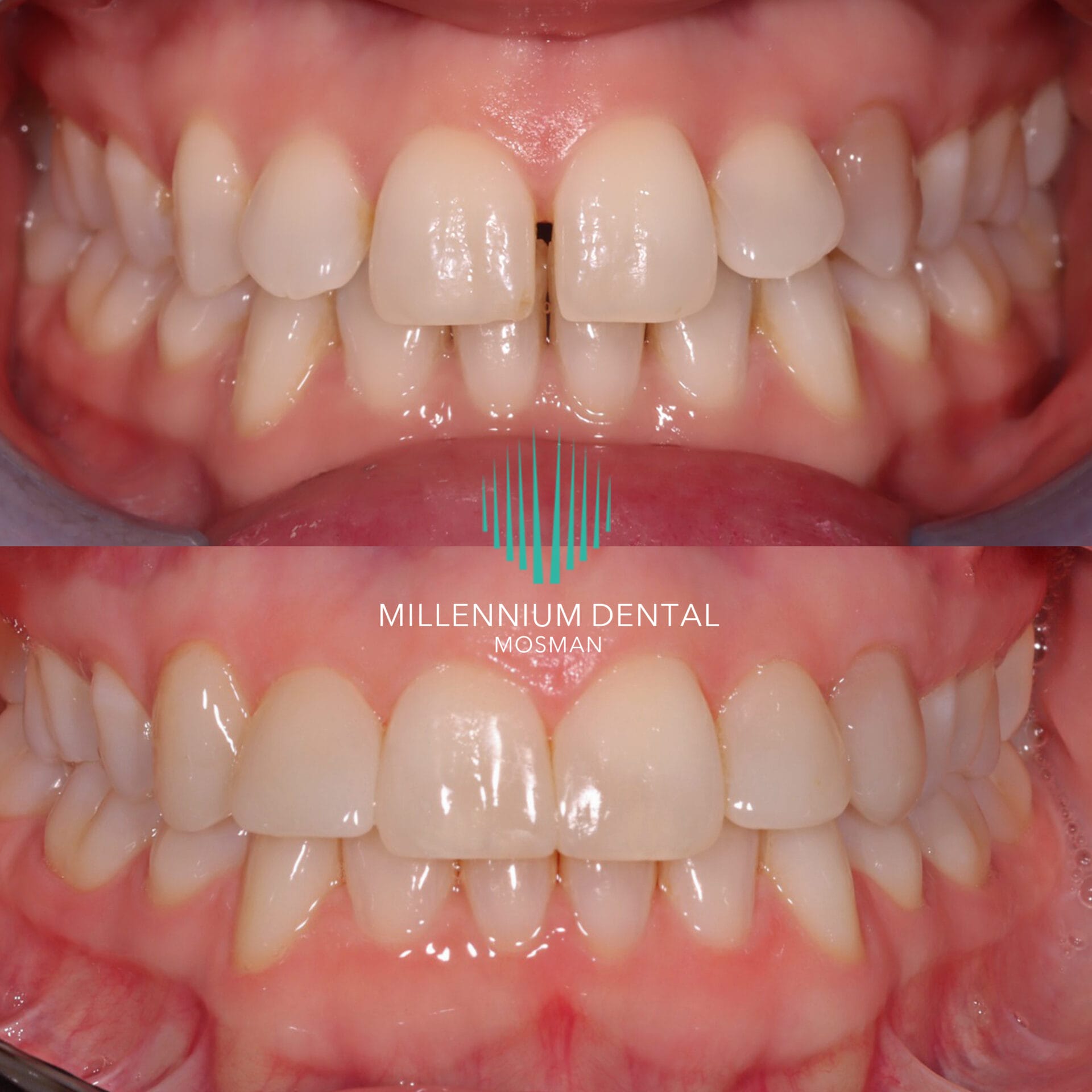 fixing gaps in teeth with composite