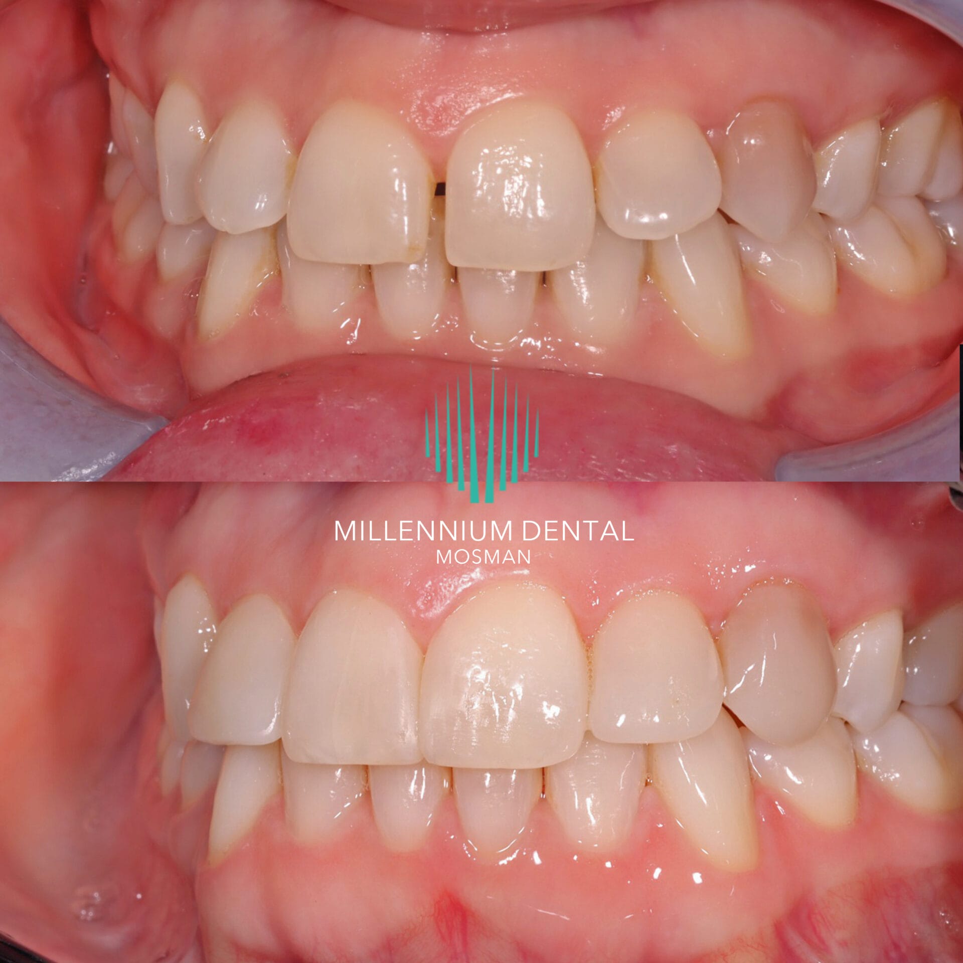 Alternative to porcelain veneer