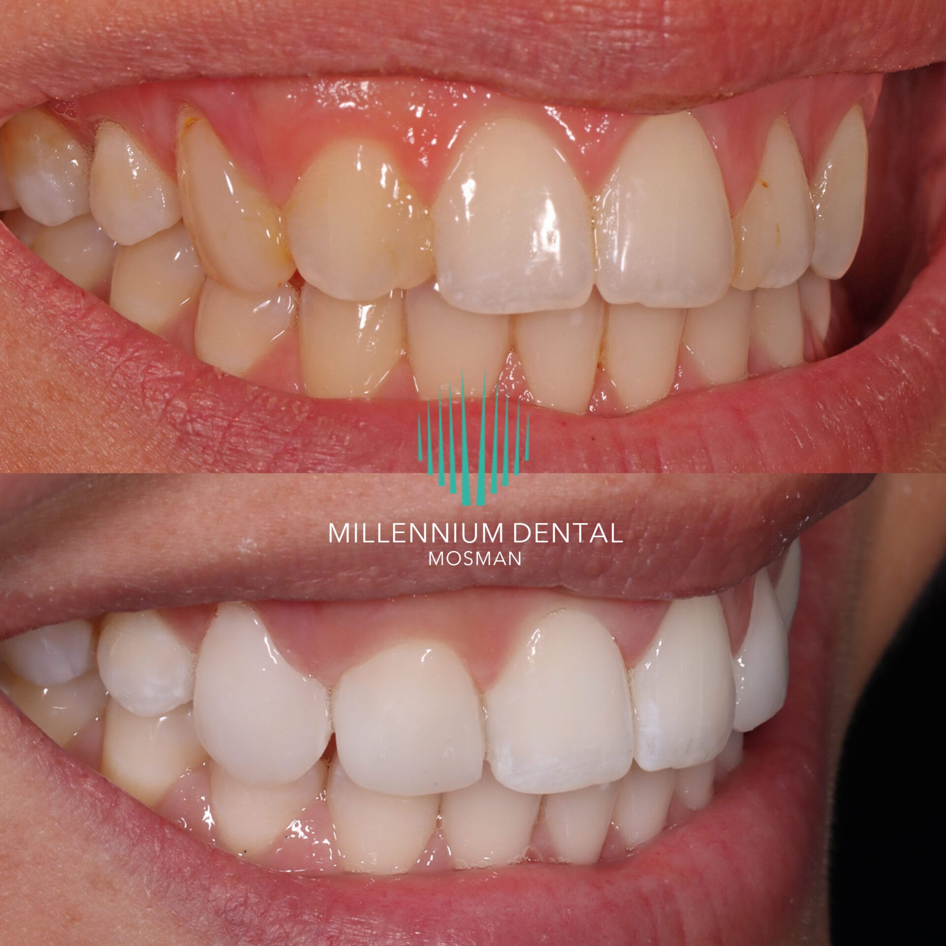 Dental Composite Bonding