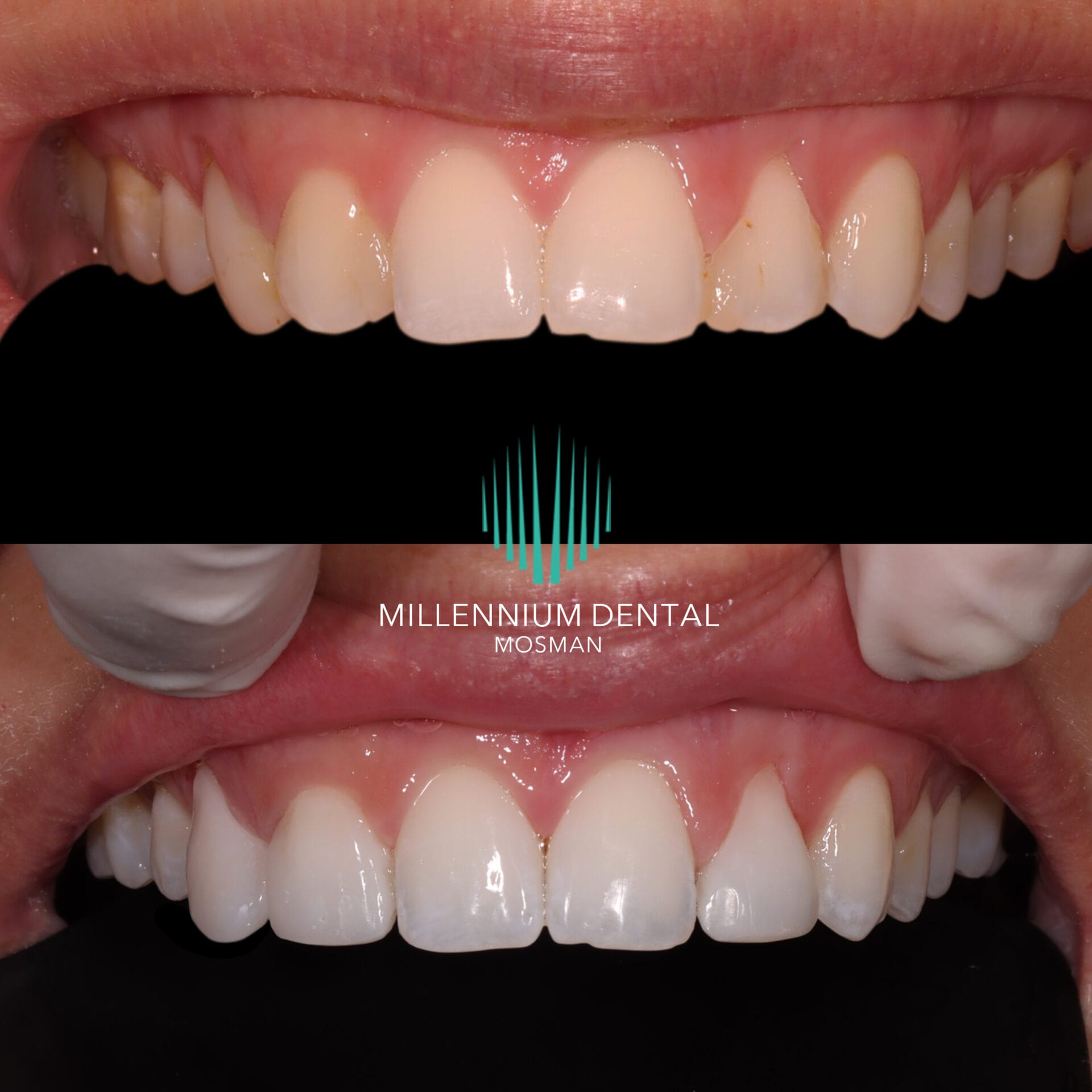 Composite bonding