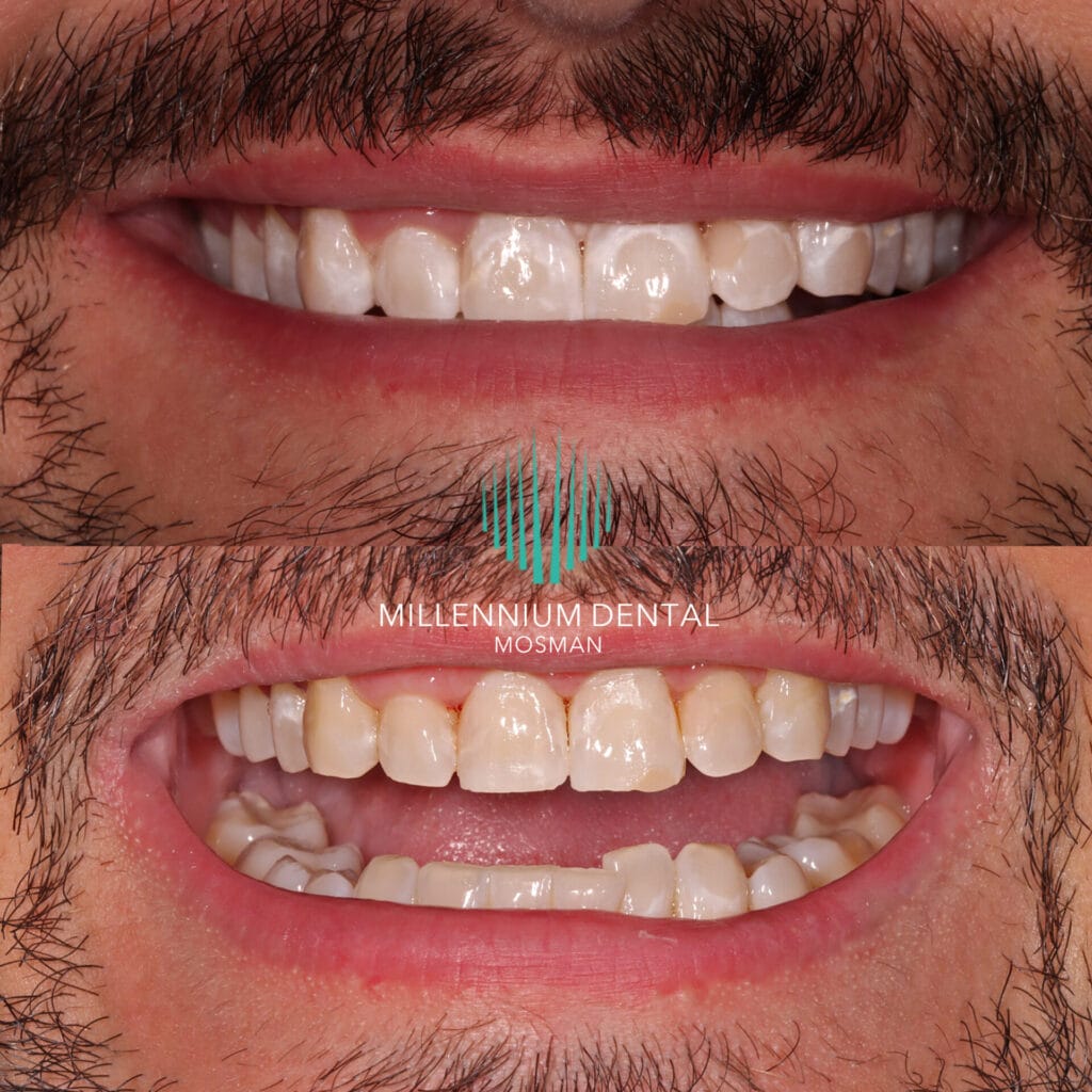 Before and after of Icon Resin Infiltration